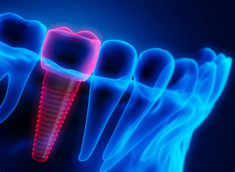 How Can Dental Implants Restore Your Natural Smile Racine Mt