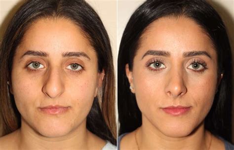 The Importance Of Skin Thickness In Rhinoplasty Dr Denton