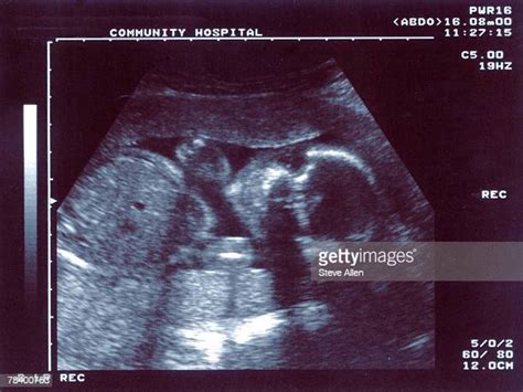 Xray When Pregnant Photos And Premium High Res Pictures Getty Images