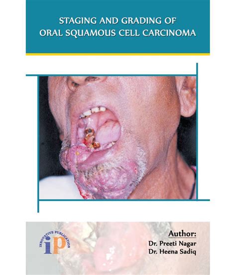 Staging And Grading Of Oral Squamous Cell Carcinoma Buy Staging And