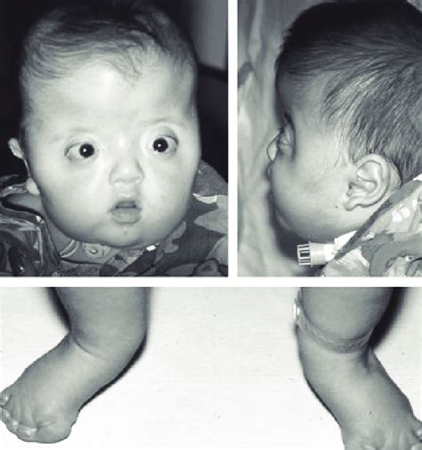 Classic Features Of Apert Syndrome Including Turribrachycephaly