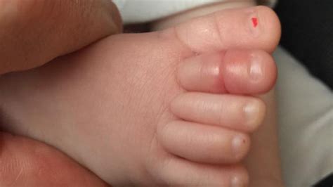 A Dads Warning On Facebook About Babys Toe Goes Viral