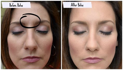 I Tried Botox And I Liked It Pretty Proof Botox Before And After Botox How To Apply