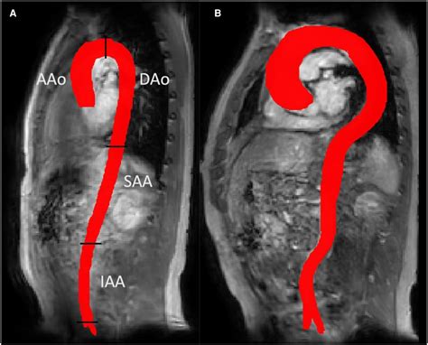 Frontiers Helical Flow In Tortuous Aortas And Its Relationship To