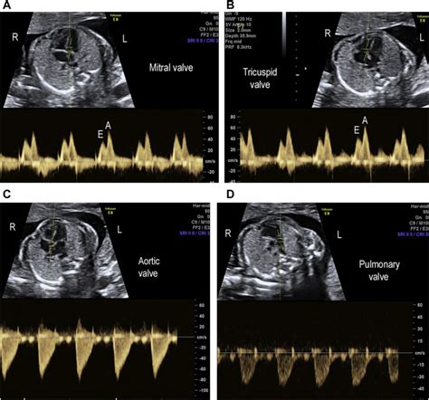 Reference Ranges For Pulsed Wave Doppler Of The Fetal Cardiac Inflow