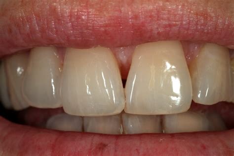 White Spots On Teeth Dazzling White Teeth Hq