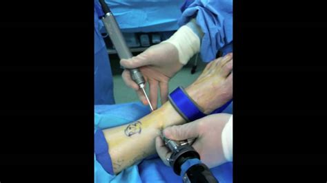 Ankle Arthroscopic Examination And Surgery Video Removal Of Damaged