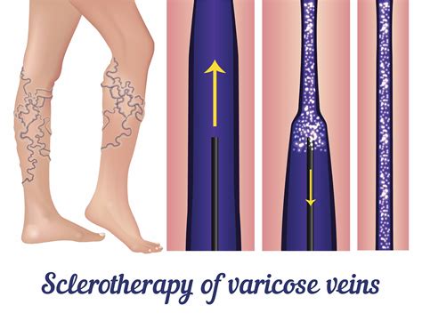 Sclerotherapy Spider Vein Treatment Vein Specialists Of The Carolinas