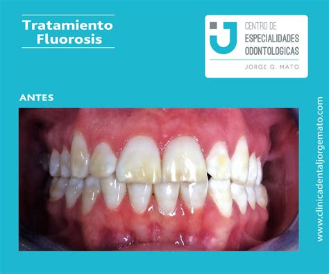 Fluorosis Dental Síntomas Y Tratamiento Clínica Dental Jorge Mato