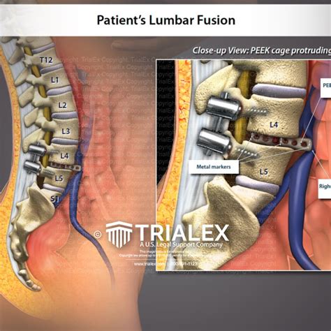 Lumbar Fusion Trialexhibits Inc