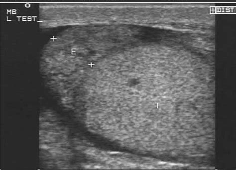 Figure 22 From Testicular Ultrasound Semantic Scholar