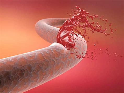 Arteriosclerosis Symptoms Causes Treatment Prevention And