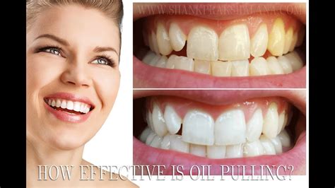 Oil Pulling Or Teeth Whitening Youtube