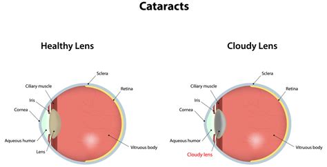 Cataract Prevention Discovery Eye Foundation