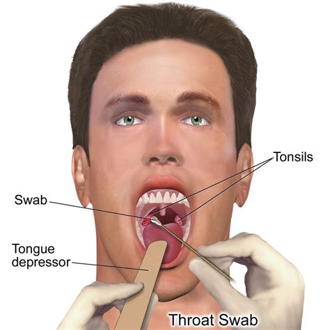 Strep Throat Symptoms Causes And How To Treat