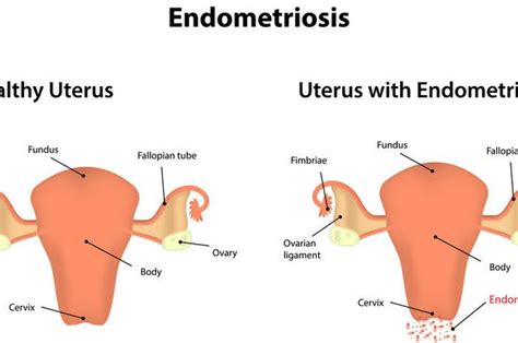 Mengenal Endometriosis Pada Wanita Bisa Sebabkan Infertilitas Rs Al Irsyad Surabaya