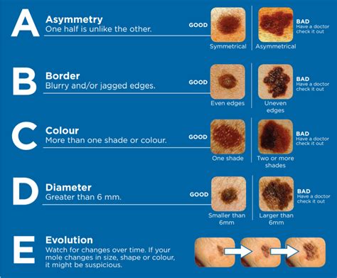 Abc Of Skin Cancer Moles Sexiz Pix