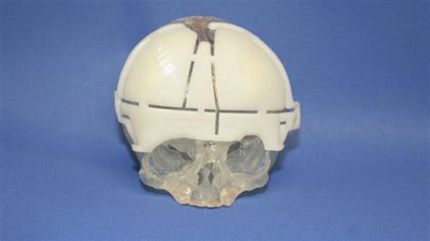 Surgeons Reconstruct Babys Skull With 3d Printing Technology Fox News