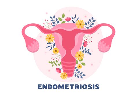 Endometriosis Con Condici N El Endometrio Crece Fuera De La Pared