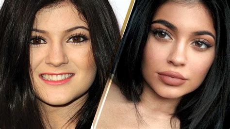 Kylie Jenners Lips How To Remove Filler — Mixed Makeup