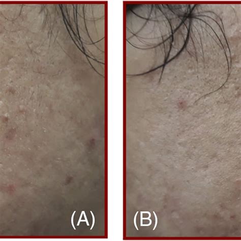 A Case Of 27 Years Old Female With Grade 2 Atrophic Acne Scar Mixed