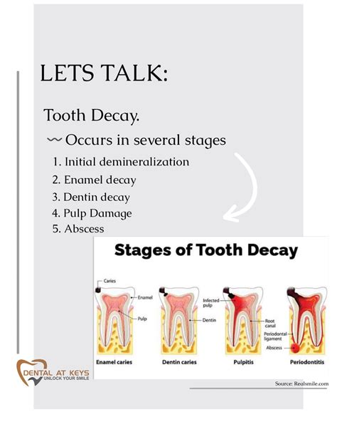 Tooth Decay Dental At Keys