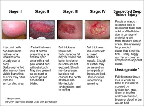 How To Prevent Diabetic Ulcers Hubpages