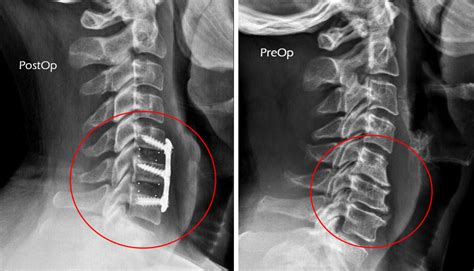 Anterior Cervical Discectomy And Fusion Acdf Radiology Case My XXX