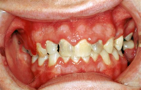 Acute Herpetic Gingivostomatitis Stock Image C Science Photo Library