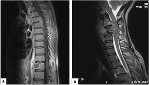 Cervical And Thoracic TB Spondylitis T1 And T2 Weighted MR Images A