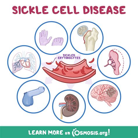 Osmosis From Elsevier On Twitter World Sickle Cell Day Is Coming Up On Monday So For Today S