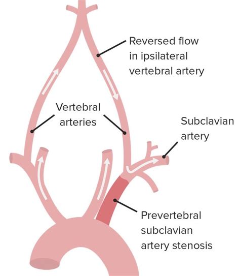 Subclavian Steal Syndrom E Learning Mit Lecturio