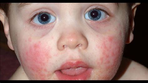 Eczema On Face Toddler 122973 Toddler Eczema On Face Cream
