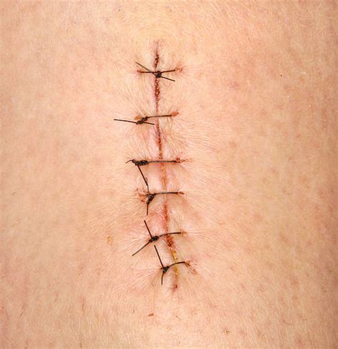 Medical Stitches Stock Photos Pictures And Royalty Free Images Istock