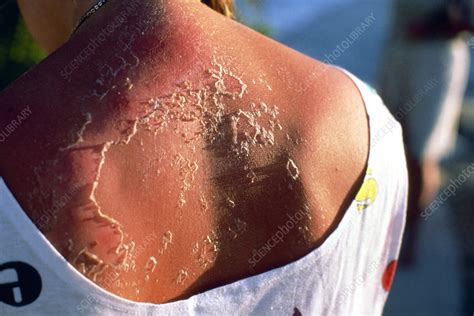 Peeling Skin On Back Of Sunburnt Woman Stock Image M335 0096 Science Photo Library