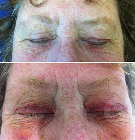 Upper Eyelid Skin Excess And Scars 10 Days After Operation Dr Sonja