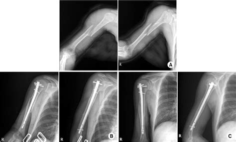 Closed Proximal 13 Humeral Fracture With An Associated Radial Nerve