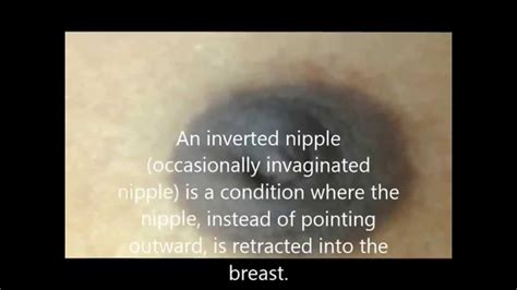 Acupunture For Inverted Nipples Dr Prakash Verekar Youtube