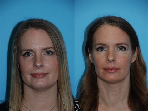 Face Itches Chin Filler Facial Contouring Facial Plastic Surgery Jowl Chevy Chase Before