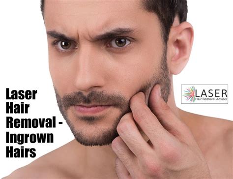 Laser hair removal offers an excellent way of removing ingrown hairs. Pin on Laser Hair Removal Info