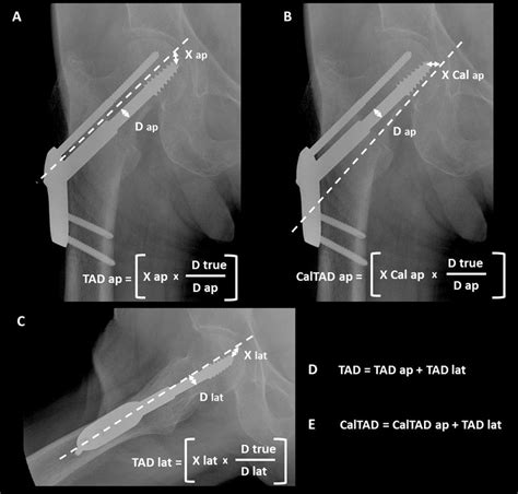 A Tip Apex Distance Calculated On Anteroposterior Radiograph Tad