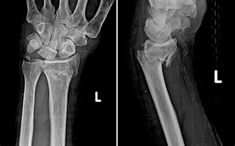 Smith Fracture Radiology