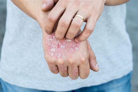 Psoriasis Patients Who Use Biologics May Be Less Likely To Develop