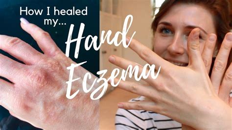 Hand Eczema Treatment Natural Cure 7 Tips How I Healed My Hand Eczema