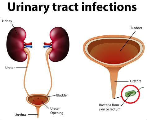 Urinary Tract Infection Causes Symptoms And Treatment January