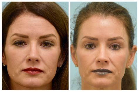 Eyelid Plastic Surgery Before And After Before And After