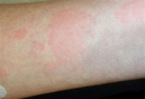 Erythema Marginatum Pictures Symptoms Treatment Causes Symptoms