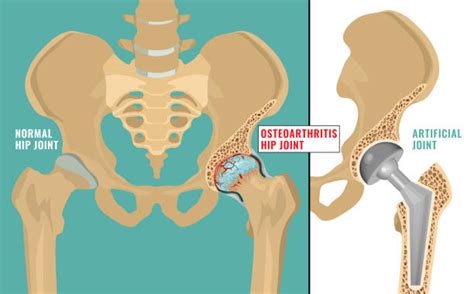 Groin Pain Illustrations Royalty Free Vector Graphics And Clip Art Istock