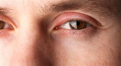 Swollen Eyelids Optometrist In Beaverton Or Sunset Eye Clinic
