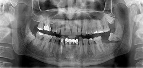 Iatrogenic Mandibular Fracture Associated with Third Molar ...